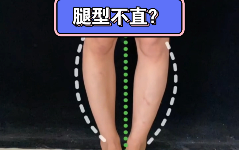怎么矫正ox型腿小常识_矫正腿型小红书_矫正小腿腿型